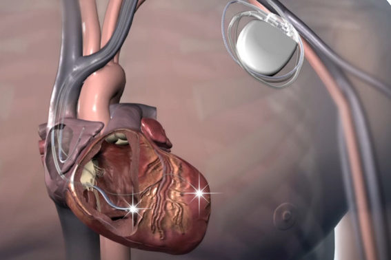 Cardiodesfibriladores implantables